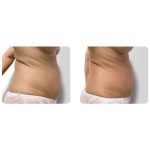 REMODELACIÓN ABDOMINAL Radiofrecuencia Indiba Zaragoza