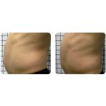 REMODELACIÓN ABDOMINAL Radiofrecuencia Indiba Zaragoza